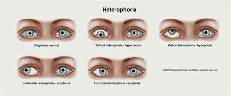 Recurring headaches A simple at-home test can help you determine if binocular vision dysfunction could be the cause. . Vertical heterophoria self test